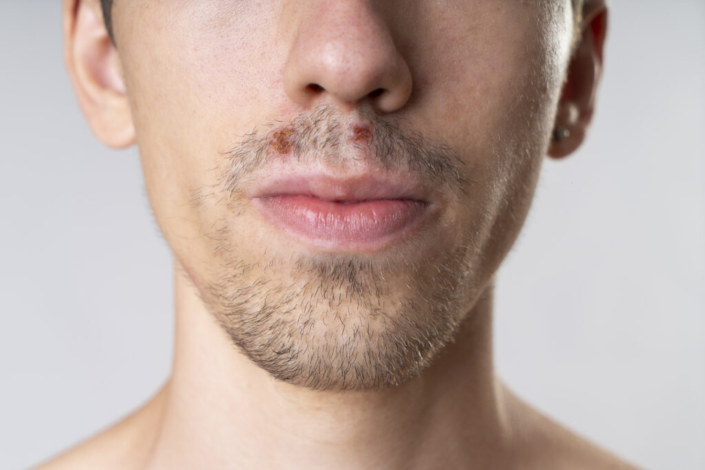 man's face with meth sores