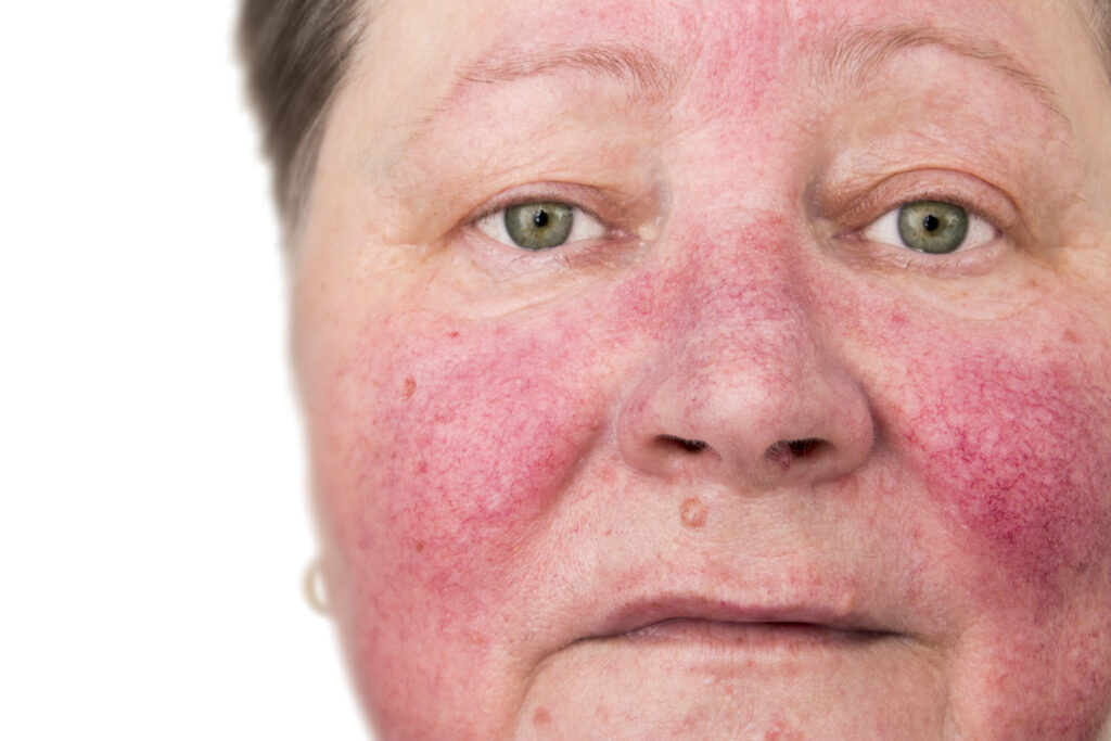 alcoholic-nose-symptoms-causes-and-treatment-options