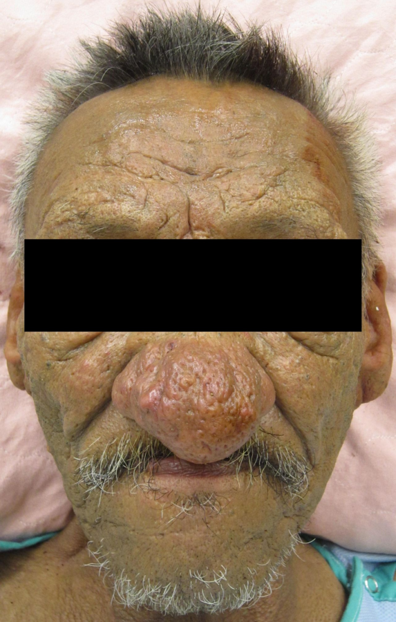 An example of severe rhinophyma.